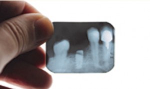 dental x-rays and cleaning